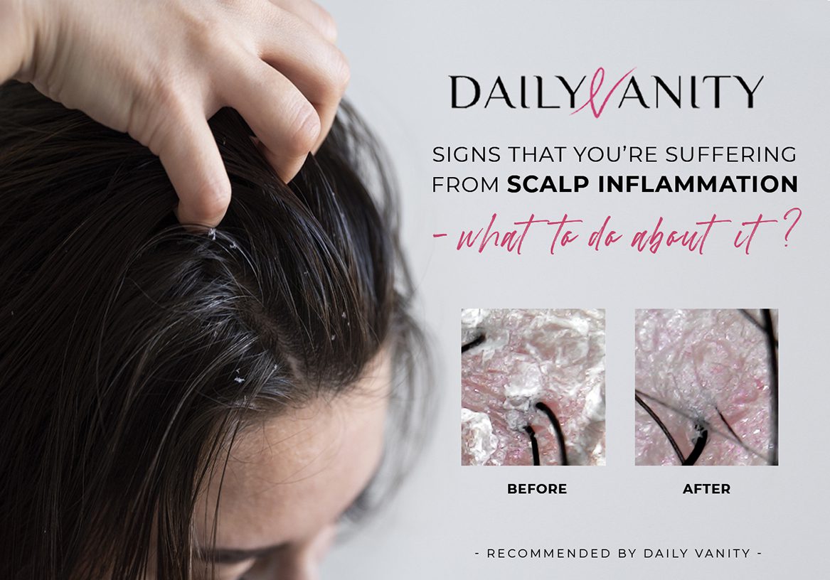 Choose Daily Vanity for Scalp Inflammation Issues