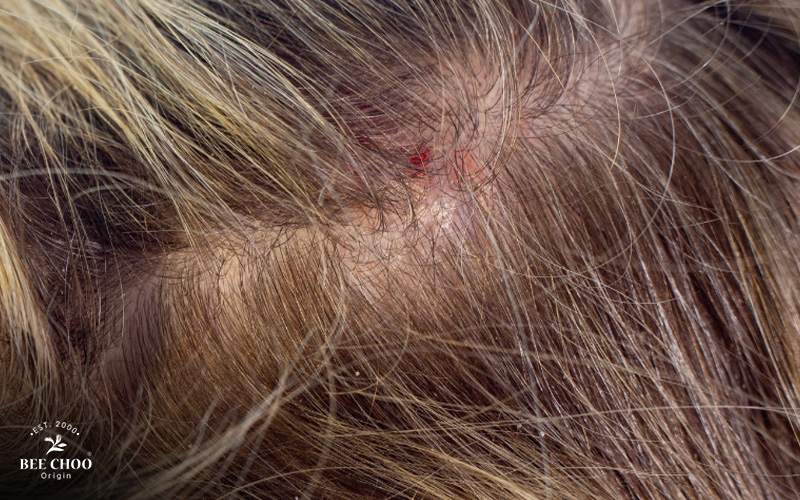 Women having a scalp inflammation