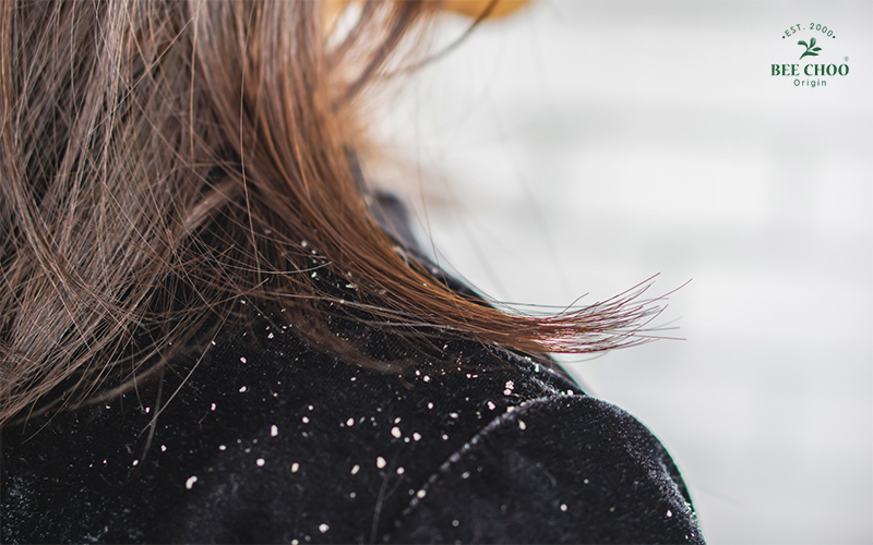 Dandruff on shoulder