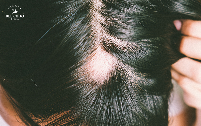 Close-up of a person's scalp showing thinning hair and a visible bald spot.