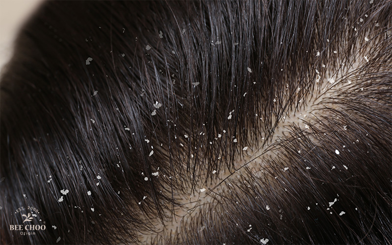 A person's scalp with dandruff