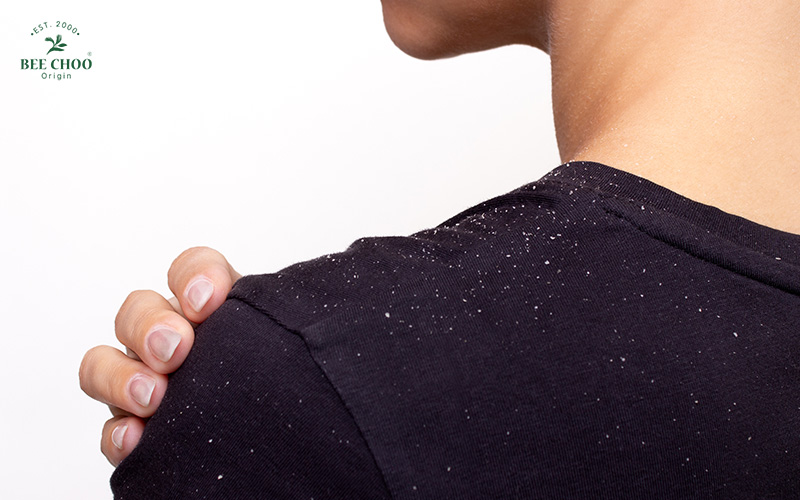 Dandruff flakes on a man's black shirt shoulder.