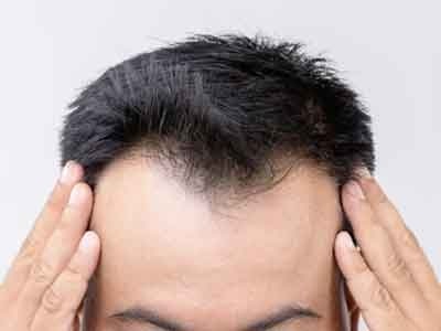 Male having M Pattern hairline due to male pattern hair loss