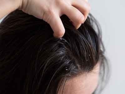 dry scalp flakes on hair
