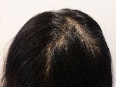 oily scalp 1