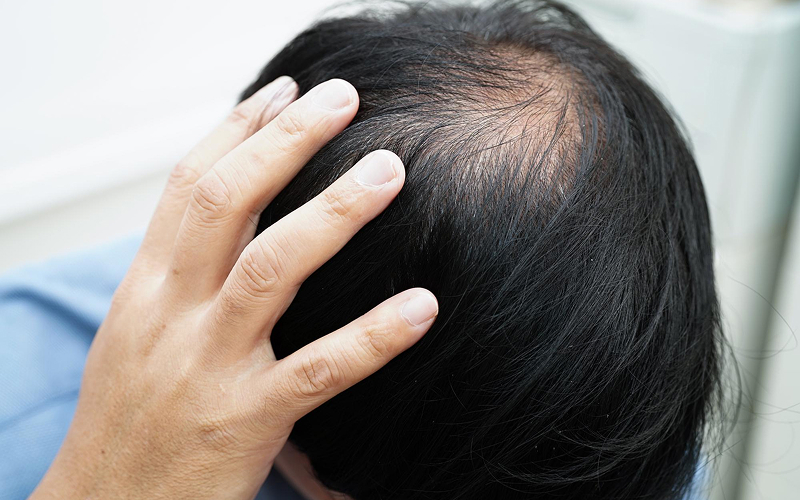 Man examining visible hair thinning on an ageing scalp.